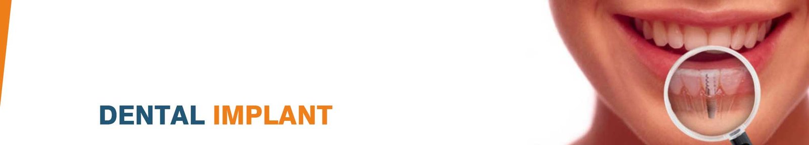 Affordable Dental Implants in India