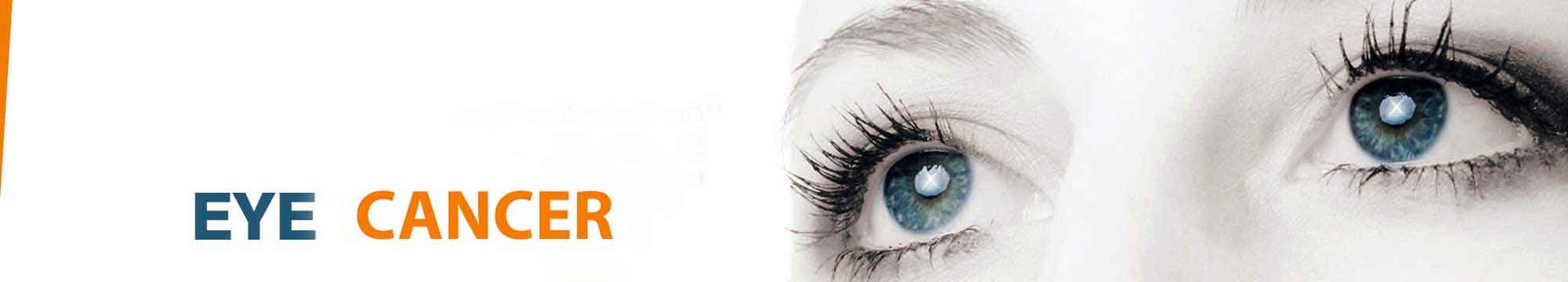 Eye Cancer Treatment India