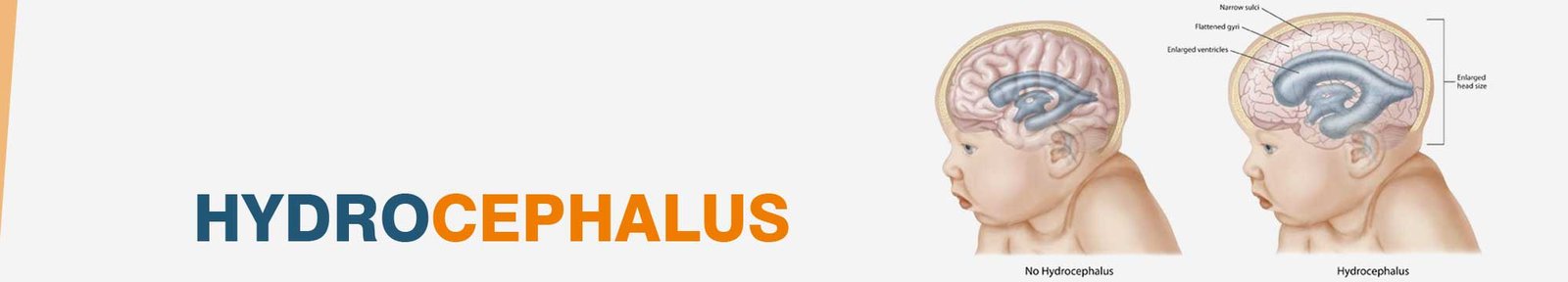 cost of hydrocephalus treatment in India