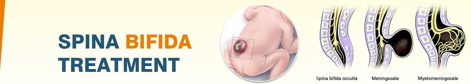 Spina Bifida Treatment in India