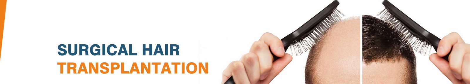 Hair Transplant Cost in India