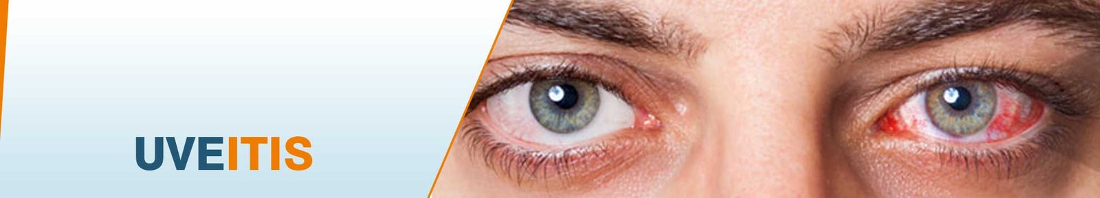 Uveitis Symptoms