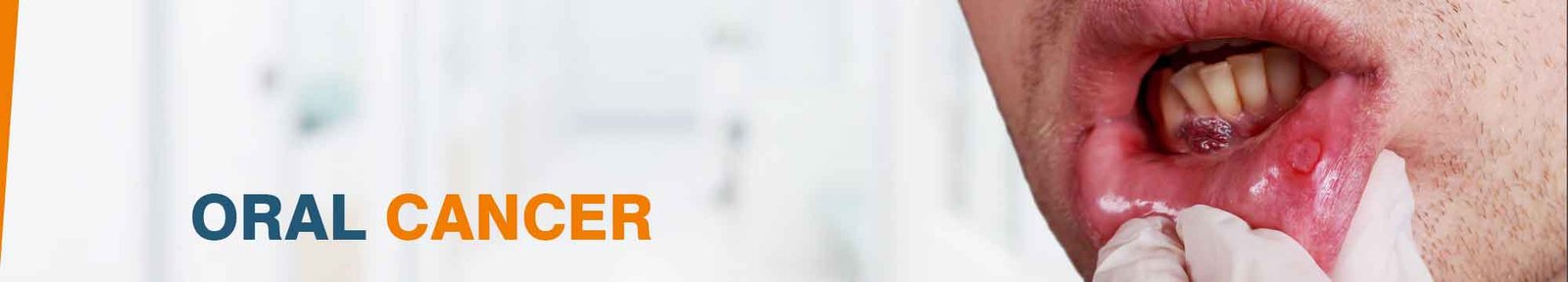 Affordable Oral Cancer Treatment in India,